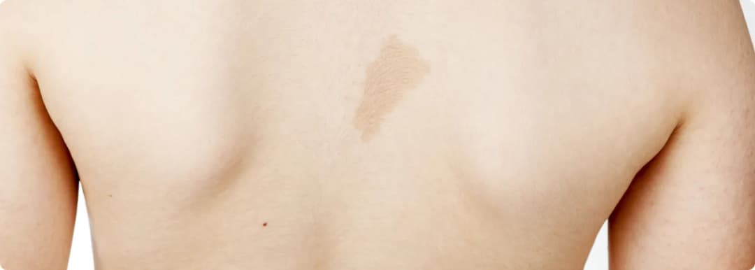 Milchkaffee Fleck: Ursachen, Behandlung und wichtige Informationen